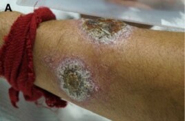 Pústulas debidas a la Leishmaniasis en el antebrazo de un cubano de 46 años que cruzó el Darién.